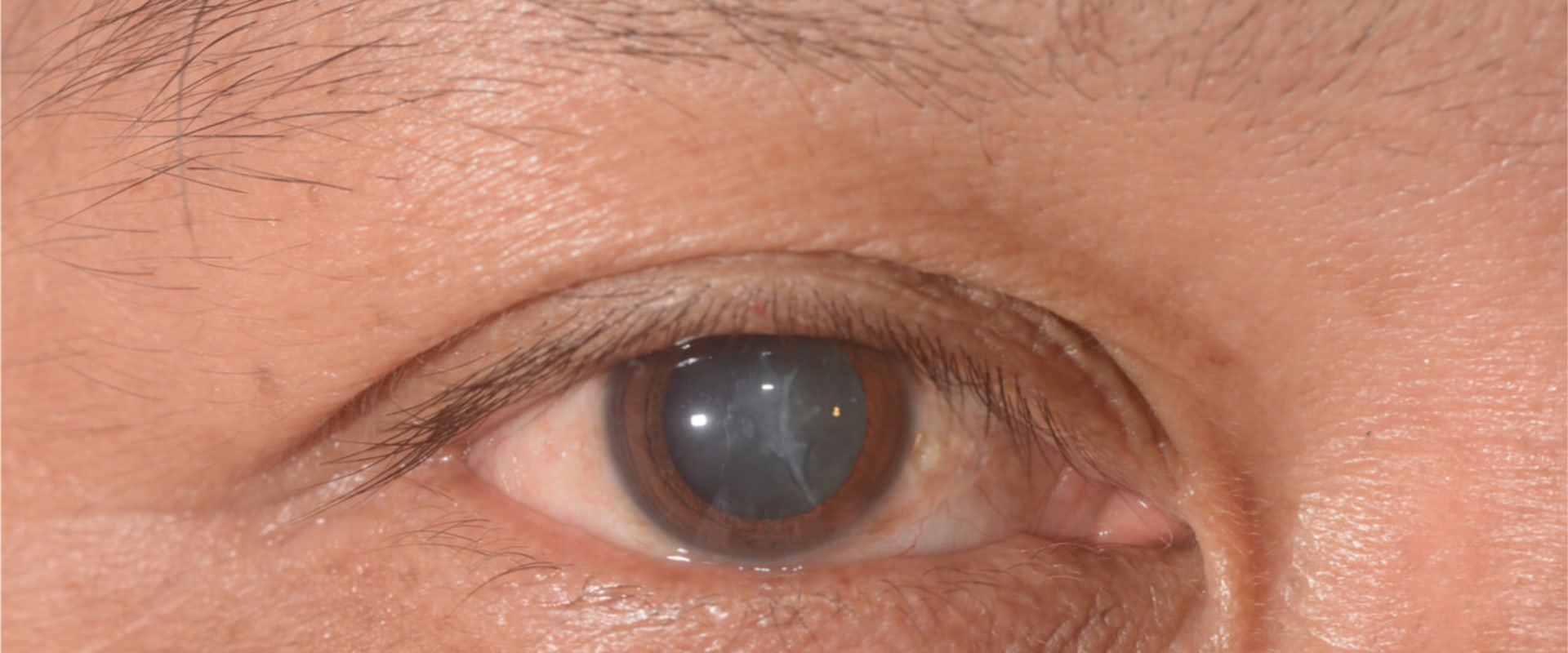 How Common are Eye Infections After Cataract Surgery?