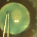 How Long Does Vision Fluctuate After Cataract Surgery?