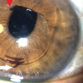 How do i know if i have an infection after cataract surgery?