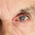 What to Expect from Cataract Surgery