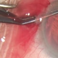 Which Cataract Surgery is Safest?